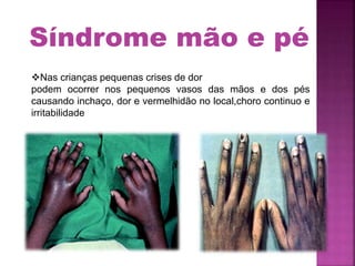Nas crianças pequenas crises de dor
podem ocorrer nos pequenos vasos das mãos e dos pés
causando inchaço, dor e vermelhidão no local,choro continuo e
irritabilidade
Síndrome mão e pé
 