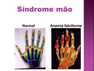 Normal Anemia falciforme
Síndrome mão
 