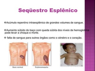 Acúmulo repentino intraesplênico de grandes volumes de sangue.
Aumento súbido do baço com queda súbita dos níveis de hemoglobina
pode levar a choque e morte.
 falta de sangue para outros órgãos como o cérebro e o coração.
Seqüestro Esplênico
 
