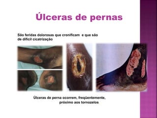 Úlceras de perna ocorrem, freqüentemente,
próximo aos tornozelos.
São feridas dolorosas que cronificam e que são
de difícil cicatrização
Úlceras de pernas
 