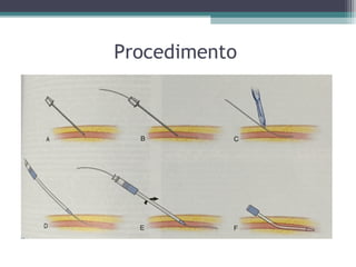 Procedimento
 