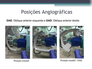 Posições Angiográficas
Posição cranial Posição caudal - OAE
OAE: Oblíqua anterior esquerda e OAD: Oblíqua anterior direita
 