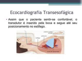 Ecocardiografia Transesofágica
• Assim que o paciente sentir-se confortável, o
transdutor é inserido pela boca e segue até seu
posicionamento no esôfago.
 