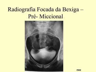 Radiografia Focada da Bexiga –
Pré- Miccional
rxw
 