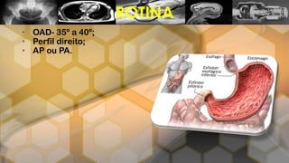 • OAD- 35º a 40º;
• Perfil direito;
• AP ou PA.
ROTINA
 