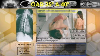OAD 35º A 40º
Obliqua de 35 a 40º - RC ┴ RI a nível de T5 ou T6 (de 5 a 7,5cm
abaixo da incisura jugular)
DFRI – 1,80m
DFRI – 1m
Colimação:
de 12 a 15cm
de largura
Bário espesso – duas ou três colheres de bário ingeridas. Expor o
paciente imediatamente ao último bolo de bário deglutido.
Bário ralo –deglutição contínua pelo canudo e exposição feita
depois de três a quatro deglutições sem suspender a respiração
(com tempo de exposição o mais curto possível).
RI: 35cm x 43cm
Respiração – suspender e expor na expiração.
 