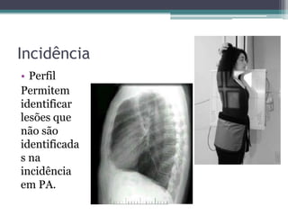 Incidência
• Perfil
Permitem
identificar
lesões que
não são
identificada
s na
incidência
em PA.
 