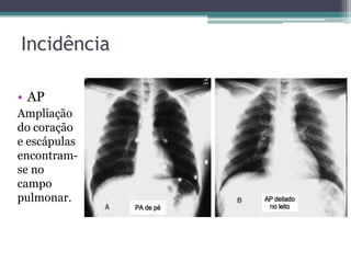 Incidência
• AP
Ampliação
do coração
e escápulas
encontram-
se no
campo
pulmonar.
 