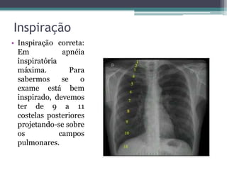 Inspiração
• Inspiração correta:
Em apnéia
inspiratória
máxima. Para
sabermos se o
exame está bem
inspirado, devemos
ter de 9 a 11
costelas posteriores
projetando-se sobre
os campos
pulmonares.
 