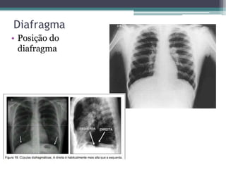 Diafragma
• Posição do
diafragma
 