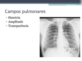 Campos pulmonares
• Simetria
• Amplitude
• Transparência
 