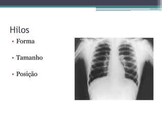Hilos
• Forma
• Tamanho
• Posição
 