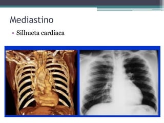Mediastino
• Silhueta cardíaca
 