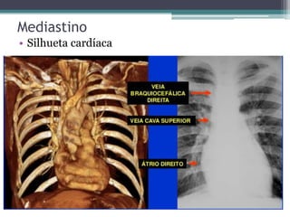 Mediastino
• Silhueta cardíaca
 