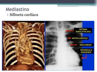 Mediastino
• Silhueta cardíaca
 