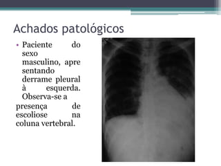Achados patológicos
• Paciente do
sexo
masculino, apre
sentando
derrame pleural
à esquerda.
Observa-se a
presença de
escoliose na
coluna vertebral.
 