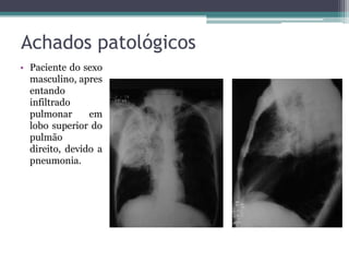 Achados patológicos
• Paciente do sexo
masculino, apres
entando
infiltrado
pulmonar em
lobo superior do
pulmão
direito, devido a
pneumonia.
 