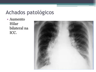 Achados patológicos
• Aumento
Hilar
bilateral na
ICC.
 