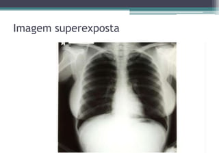 Imagem superexposta
 