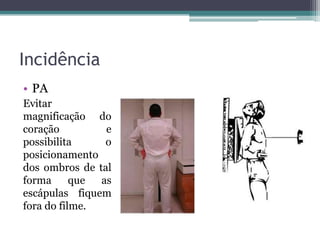 Incidência
• PA
Evitar
magnificação do
coração e
possibilita o
posicionamento
dos ombros de tal
forma que as
escápulas fiquem
fora do filme.
 