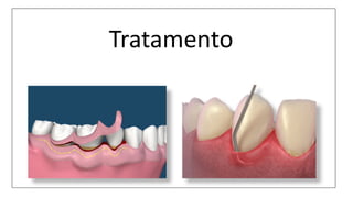Tratamento
 