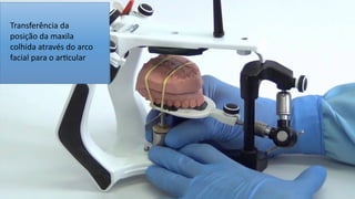 Transferência da
posição da maxila
colhida através do arco
facial para o ar$cular
 