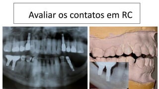 Avaliar os contatos em RC
 