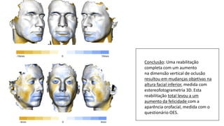 Conclusão: Uma reabilitação
completa com um aumento
na dimensão vertical de oclusão
resultou em mudanças objetivas na
altura facial inferior, medida com
estereofotogrametria 3D. Esta
reabilitação total levou a um
aumento da felicidade com a
aparência orofacial, medida com o
questionário OES.
 