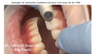 Remoção de Laminados Cerâmicos (e-max) com Laser de Er: YAG
 