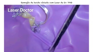 Remoção de tecido cáriado com Laser de Er: YAG
 