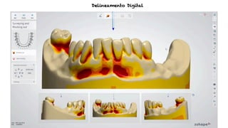 Delineamento Digital
 