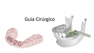 Guia Cirúrgico
 