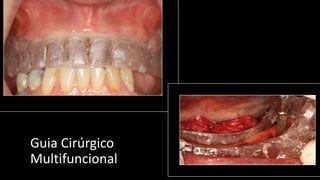 Guia Cirúrgico
Multifuncional
 