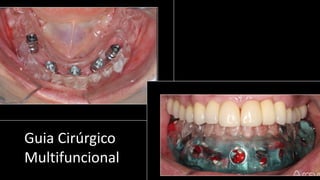 Guia Cirúrgico
Multifuncional
 