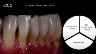 LCNC - Lesoes Cervicais Nao Cariosas
~ ~
Não
Interferência
Oclusal
Mul$fatorial
Interferência
Oclusal
 