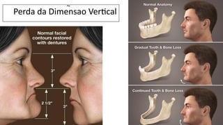 Perda da Dimensao VerBcal
~
 