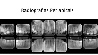 Radiografias Periapicais
 