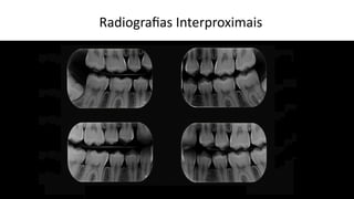 Radiograﬁas Interproximais
 