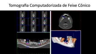 Tomograﬁa Computadorizada de Feixe Cônico
 