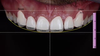 2mm
0mm
1,5mm
1,5mm
1,5mm 1mm
0,9mm
1,5mm
2mm
 