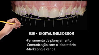 -Ferramenta de planejamento
-Comunicação com o laboratório
-Marketing e venda
Digital Smile Design
DSD -
 