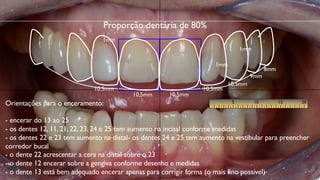 Proporção dentária de 80%
Orientações para o enceramento:
- encerar do 13 ao 25
- os dentes 12, 11, 21, 22, 23, 24 e 25 tem aumento na incisal conforme medidas
- os dentes 22 e 23 tem aumento na distal- os dentes 24 e 25 tem aumento na vestibular para preencher
corredor bucal
- o dente 22 acrescentar a cera na distal sobre o 23
- o dente 12 encerar sobre a gengiva conforme desenho e medidas
- o dente 13 está bem adequado encerar apenas para corrigir forma (o mais fino possível)
10,5mm
10,5mm
10,5mm
10,5mm
10,5mm
9mm
8mm
1mm
1mm
1mm
 