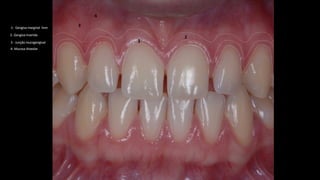 1- Gengiva marginal livre
4- Mucosa Alveolar
2- Gengiva Inserida
1
2
3
4
3 - Junção mucogengival
 