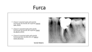 Furca
• Classe I caracterizada pela perda
horizontal do tecido de suporte menor
que 3mm
• Classe II caracterizada pela perda
horizontal do tecido de suporte maior
ou igual a 3mm
• Classe III caracterizada pela perda
horizontal dos tecidos de um lado a
outro da furca
Sonda Nabers
 