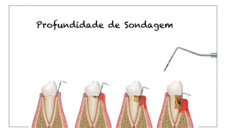 Profundidade de Sondagem
 