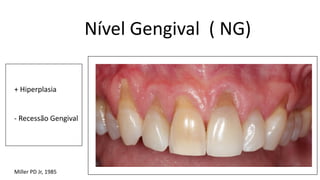 Nível Gengival ( NG)
+ Hiperplasia
- Recessão Gengival
Miller PD Jr, 1985
 