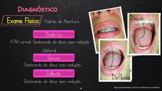 Diagnóstico
Exame Físico: Padrão de Abertura
8 https://julianadentista.com/2012/10/05/desvio-e-deflexao/
Simétrica
Desvio
Deflexão
ATM normal. Deslocando do disco sem redução
bilateral.
Deslocando do disco com redução.
Deslocando do disco sem redução.
 
