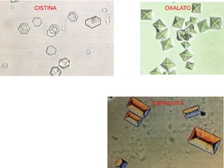 CISTINA      OXALATO




          ESTRUVITA
 