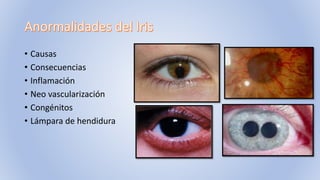 • Causas
• Consecuencias
• Inflamación
• Neo vascularización
• Congénitos
• Lámpara de hendidura
 