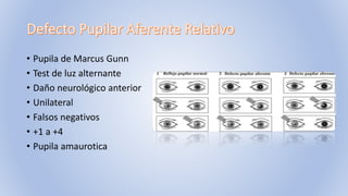 • Pupila de Marcus Gunn
• Test de luz alternante
• Daño neurológico anterior
• Unilateral
• Falsos negativos
• +1 a +4
• Pupila amaurotica
 